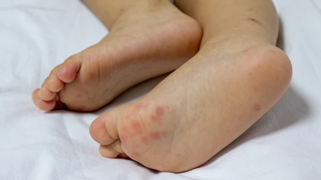 Trẻ bị tay chân miệng cách ly bao lâu? Hướng dẫn chăm sóc và phòng bệnh