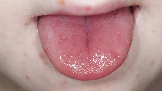 Trẻ bị tay chân miệng khi nào cần nhập viện? Dấu hiệu nhận biết