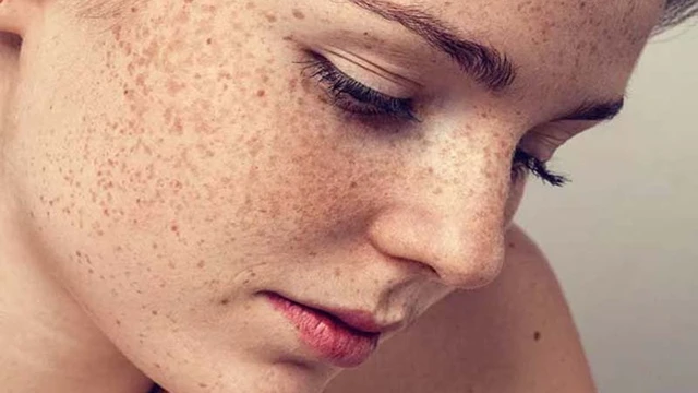 bai-viet/tri-cham-doi-moi-tren-mat-hieu-qua-bang-cac-nguyen-lieu-quen-thuoc-50819.html