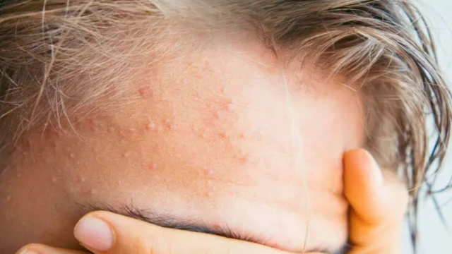 bai-viet/tri-mun-an-duoi-da-nhu-the-nao-de-mang-lai-hieu-qua-an-toan.html