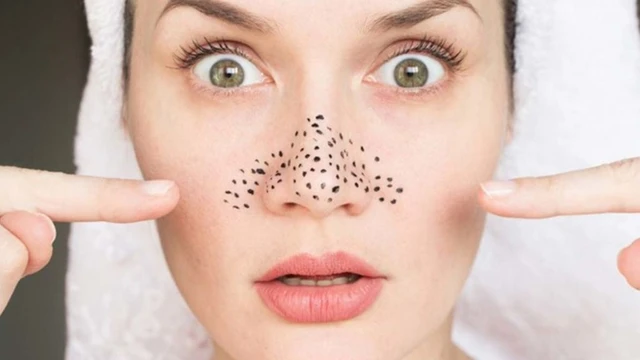 bai-viet/tri-mun-dau-den-o-mui-bang-bha-va-nhung-luu-y-can-biet.html