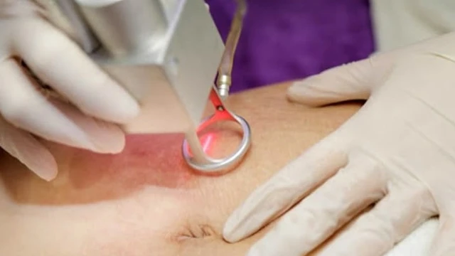 bai-viet/tri-ran-da-sau-sinh-bang-laser-co-hieu-qua-khong-57042.html