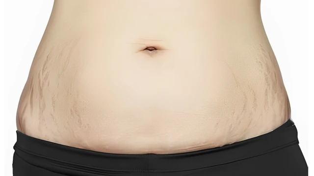 bai-viet/chia-se-cach-tri-ran-da-sau-sinh-mo-an-toan-hieu-qua.html