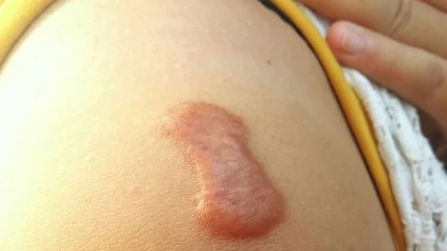 bai-viet/tri-seo-loi-gay-ngua-don-gian-va-hieu-qua-54772.html