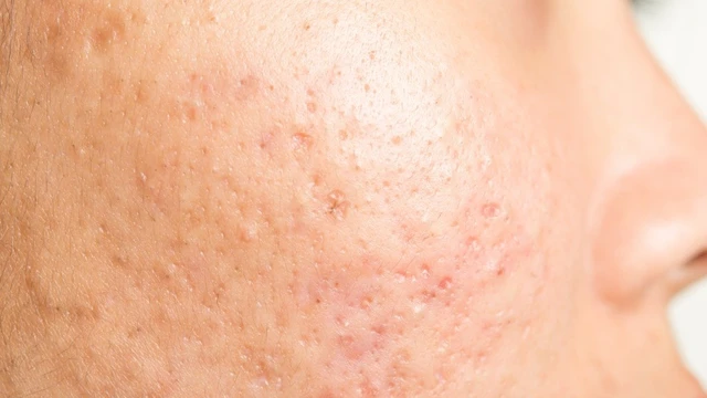 bai-viet/tri-seo-ro-gia-bao-nhieu-cac-phuong-phap-tri-seo-ro-pho-bien-hien-nay.html