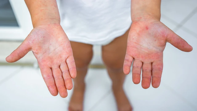 Triệu chứng bệnh tay chân miệng ngày thứ 3 là gì? Cách chăm sóc trẻ