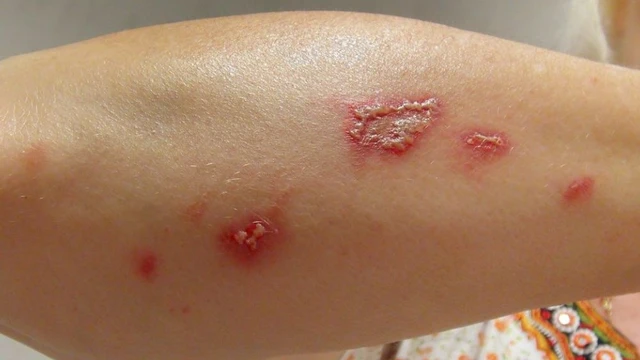 bai-viet/trieu-chung-cua-kien-ba-khoang-can-la-gi-cach-xu-ly-vet-can-nhu-the-nao.html