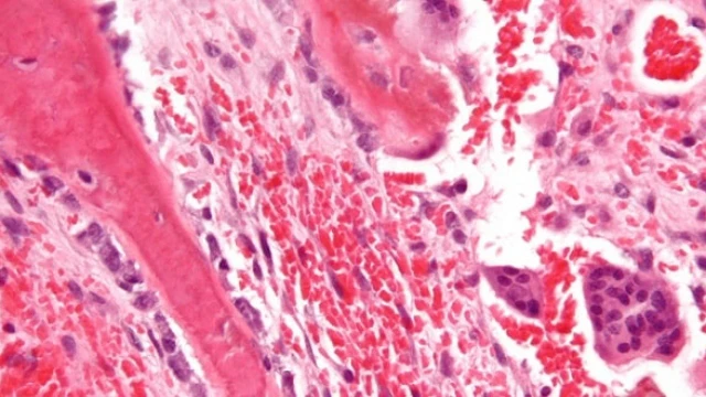 bai-viet/trieu-chung-tang-canxi-mau-trong-ung-thu-54234.html