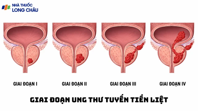 bai-viet/trieu-chung-ung-thu-tuyen-tien-liet-giai-doan-dau-can-nhan-biet.html