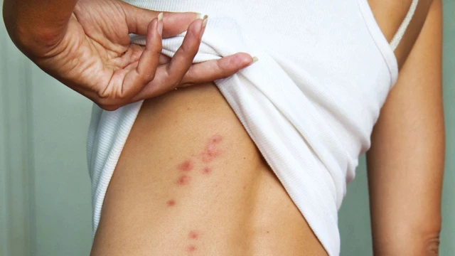 bai-viet/trieu-chung-va-dien-tien-benh-thuy-dau-o-nguoi-lon.html