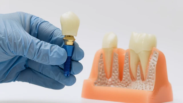 bai-viet/trong-rang-gia-gia-bao-nhieu-cap-nhat-chi-phi-moi-va-lua-chon-phu-hop.html