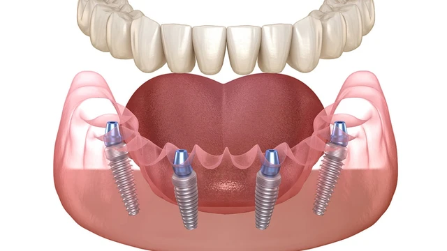 bai-viet/trong-rang-implant-all-on-4-gia-bao-nhieu-nhung-yeu-to-anh-huong-chi-phi.html