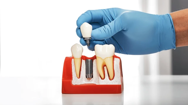 bai-viet/trong-rang-su-gia-bao-nhieu-1-chiec-cac-yeu-to-anh-huong-den-chi-phi-trong-rang-su.html