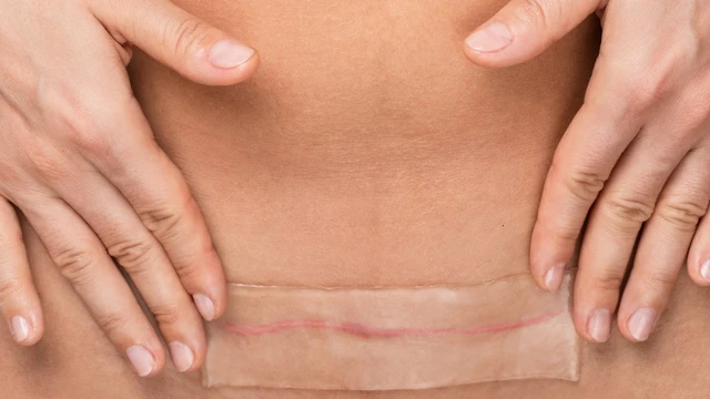 bai-viet/tu-dich-vet-mo-nguyen-nhan-va-cach-phong-ngua.html