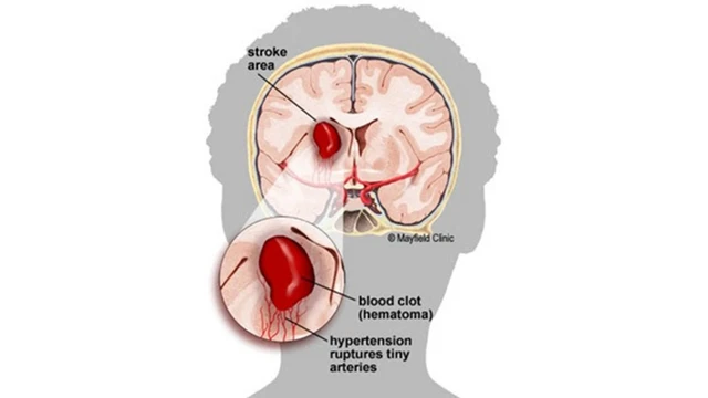 bai-viet/tu-mau-nao-nguyen-nhan-dau-hieu-va-cach-phong-tranh.html
