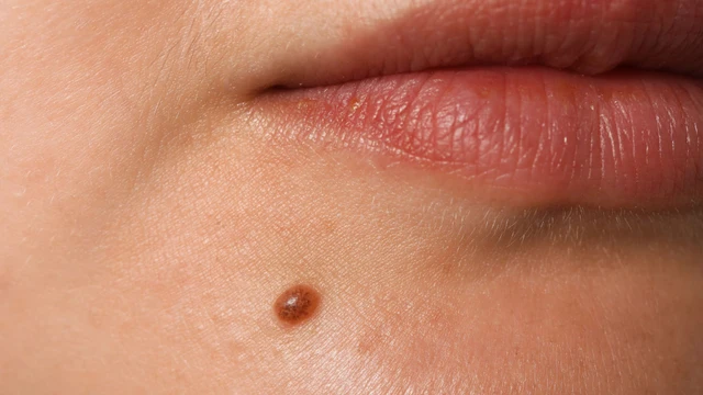 Tự nhiên mọc nốt ruồi có sao không? Sự hình thành nốt ruồi mới như thế nào?