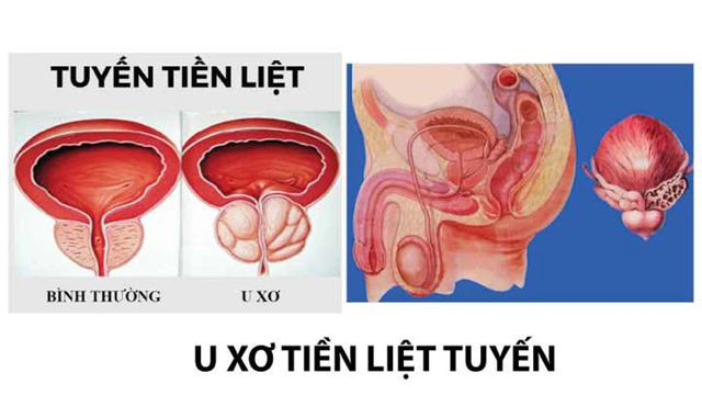 bai-viet/u-xo-tien-liet-tuyen-nen-an-gi-va-kieng-an-gi-63548.html