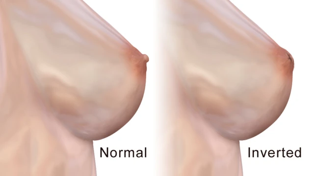 bai-viet/tut-num-vu-bam-sinh-la-gi-co-dieu-tri-duoc-khong.html