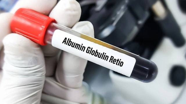 bai-viet/ty-le-albumin-globulin-la-gi-y-nghia-cua-ty-le-albumin-globulin-trong-chan-doan-va-theo-doi-benh.html