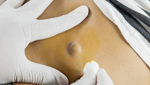 bai-viet/u-ba-dau-co-nguy-hiem-khong-phuong-phap-dieu-tri-va-phong-ngua-u-ba-dau.html