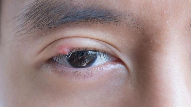 bai-viet/u-ba-dau-mi-mat-co-tai-phat-khong-dieu-tri-u-ba-dau-o-mi-mat-nhu-the-nao.html