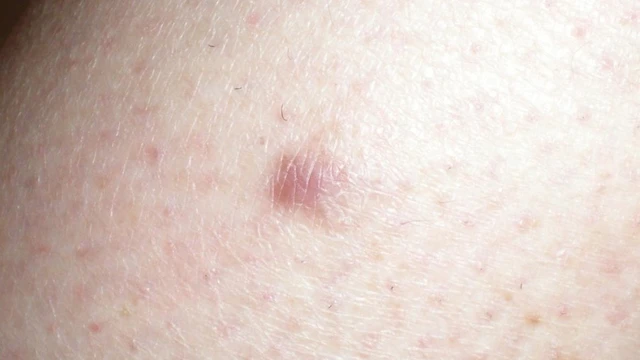 bai-viet/u-co-tron-o-da-la-gi-trieu-chung-va-cach-dieu-tri.html