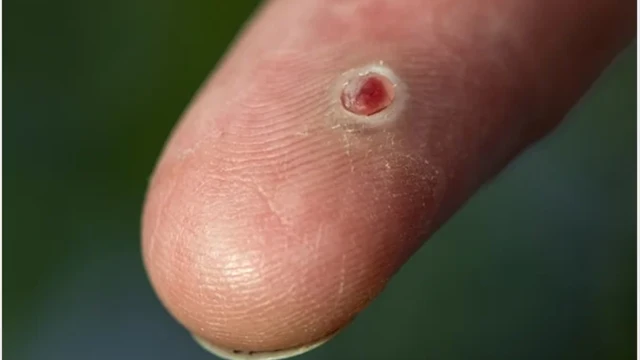 bai-viet/u-hat-nhiem-khuan-nhung-thong-tin-quan-trong-can-biet.html