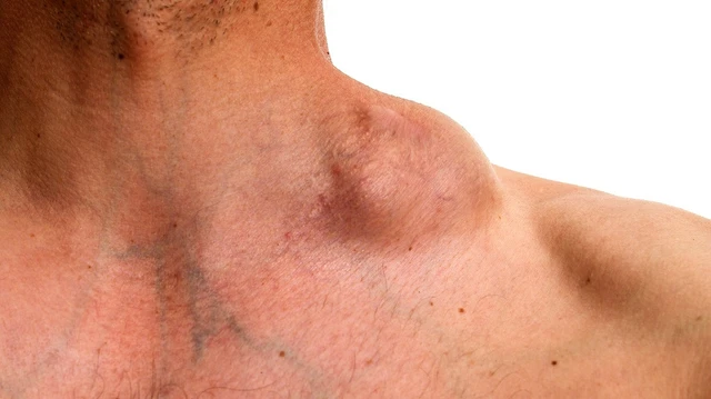 bai-viet/u-lympho-khong-hodgkin-te-bao-b-lon-toa-rong-nguyen-nhan-trieu-chung-va-dieu-tri.html