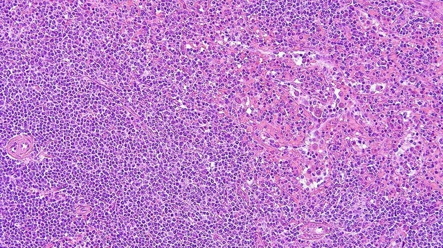 bai-viet/u-lympho-ruot-non-nguyen-nhan-trieu-chung-va-phuong-phap-dieu-tri-hieu-qua.html