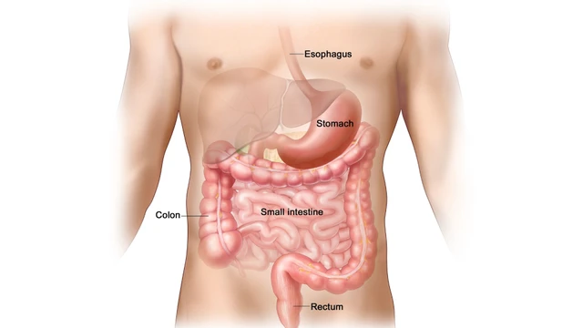 benh/u-mo-dem-duong-tieu-hoa-gists.html