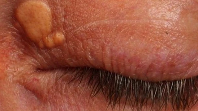 bai-viet/u-mo-vang-o-mat-nguyen-nhan-va-cach-dieu-tri.html