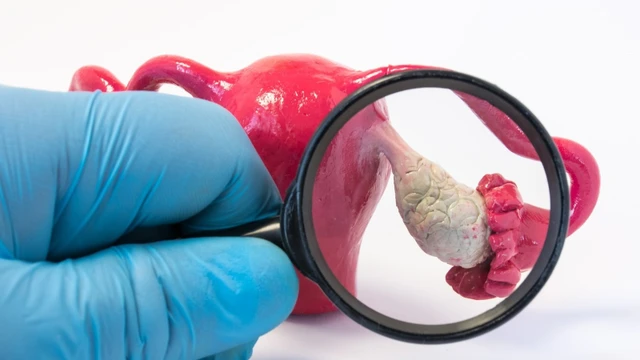 bai-viet/u-nang-don-thuy-buong-trung-co-gay-nguy-hiem-den-tinh-mang-khong.html