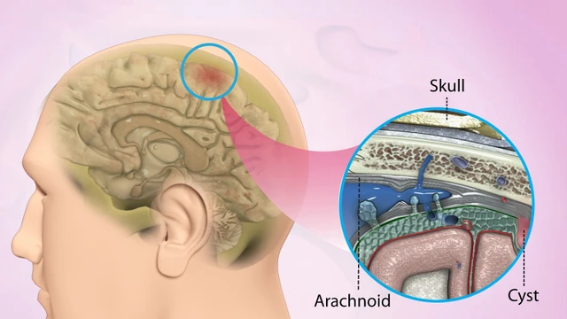 benh/u-nang-mang-nhen-nao.html