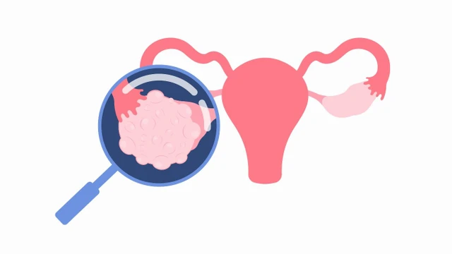 bai-viet/u-nang-va-u-xo-co-gi-khac-biet-giua-hai-loai-u-nay.html