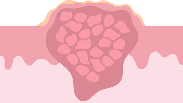 u nguyên bào xơ cơ viêm