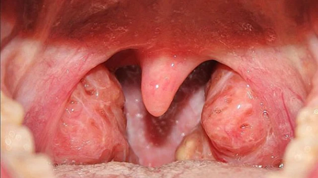 bai-viet/u-nhu-amidan-va-nhung-dieu-can-biet.html