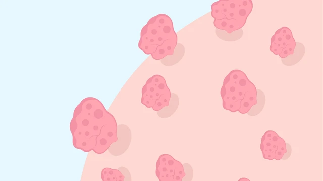 benh/u-nhu-sinh-duc.html