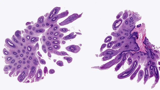 bai-viet/u-nhu-te-bao-vay-nguyen-nhan-dau-hieu-va-cach-dieu-tri.html