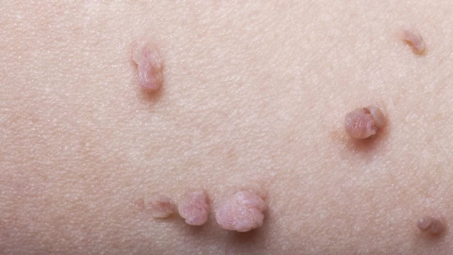 bai-viet/u-nhu-tren-da-co-nguy-hiem-hay-khong-phuong-phap-dieu-tri-u-nhu.html