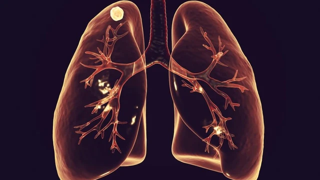 bai-viet/u-phoi-co-phai-ung-thu-phoi-khong-51850.html