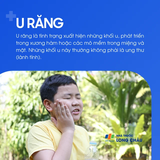 U răng là gì? Nguyên nhân, triệu chứng và cách điều trị