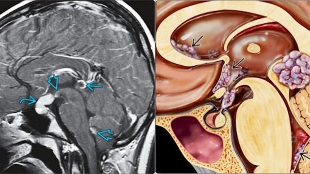 bai-viet/u-te-bao-mam-o-tre-em-gioi-thieu-59177.html