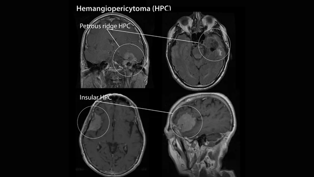U tế bào quanh mạch