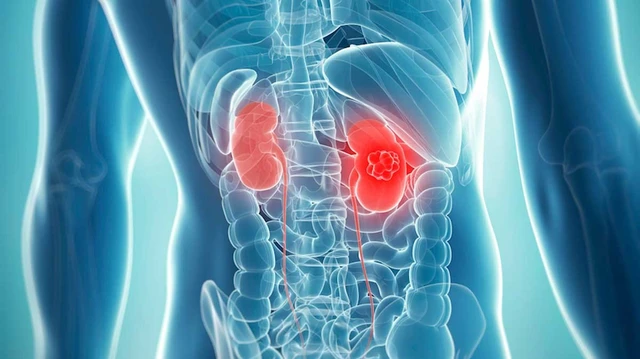 bai-viet/u-than-la-gi-nhung-cach-nhan-biet-va-dieu-tri-u-than-hieu-qua-64623.html