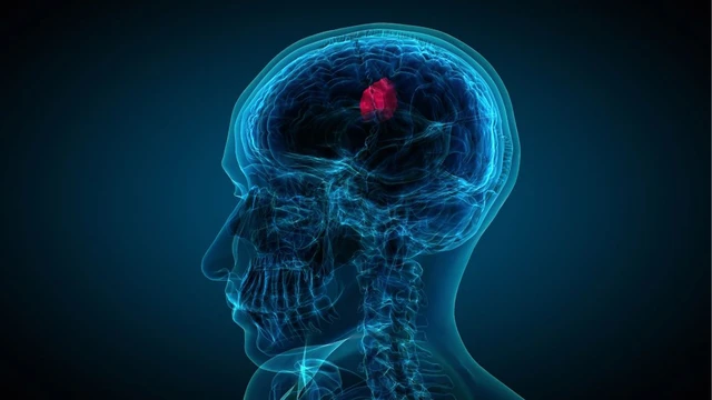 bai-viet/u-tieu-nao-trieu-chung-nhan-biet-phac-do-dieu-tri-va-tien-luong-benh.html