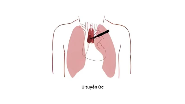U tuyến ức