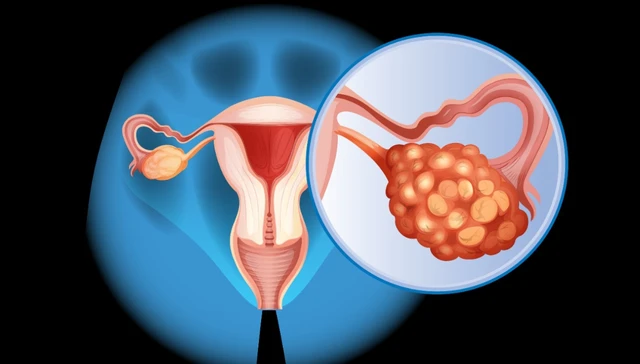 bai-viet/ung-thu-buong-trung-di-can-o-bung-tien-luong-va-phuong-phap-dieu-tri.html