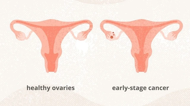 benh/ung-thu-buong-trung-giai-doan-1.html