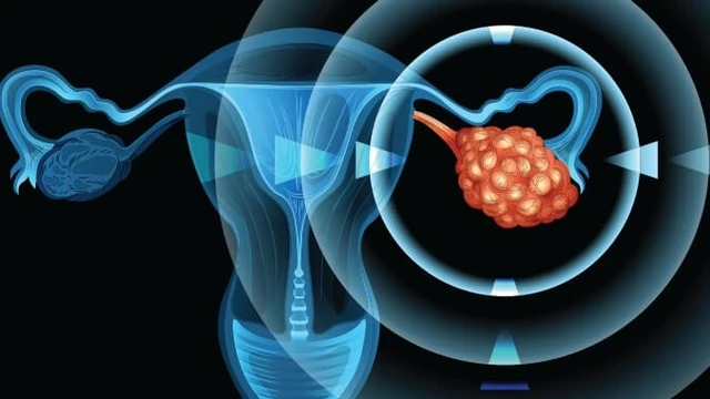 bai-viet/ung-thu-buong-trung-giai-doan-2-ty-le-song-va-huong-dieu-tri-tot-nhat.html