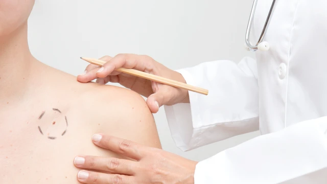 bai-viet/ung-thu-da-co-chet-khong-nhung-yeu-to-anh-huong.html